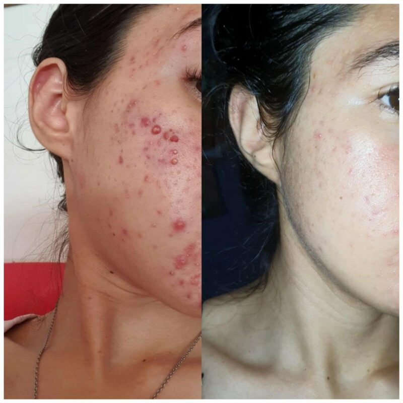 Comunidade Antiacne depoimento e resultados prints de alunos