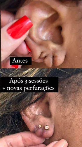 Curso Lobuloplastia Sem Corte depoimento e resultados prints de alunos